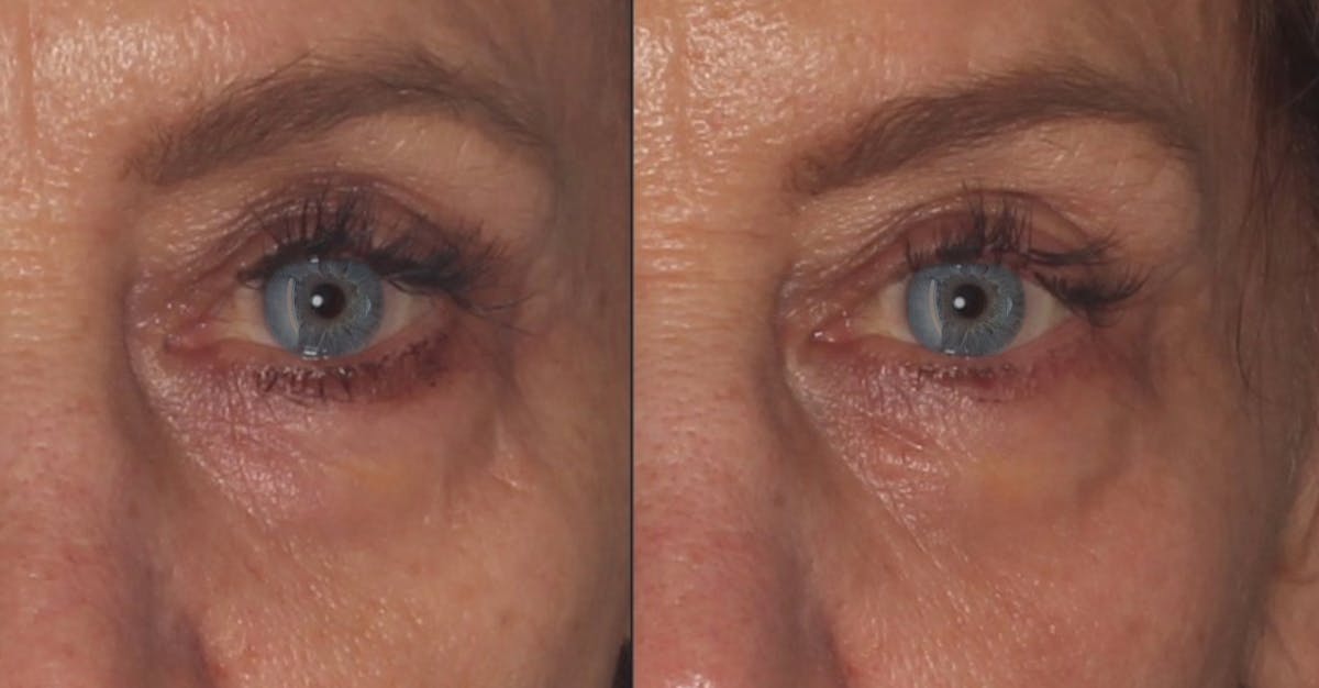 MicroFat Before & After Gallery - Patient 563980 - Image 2