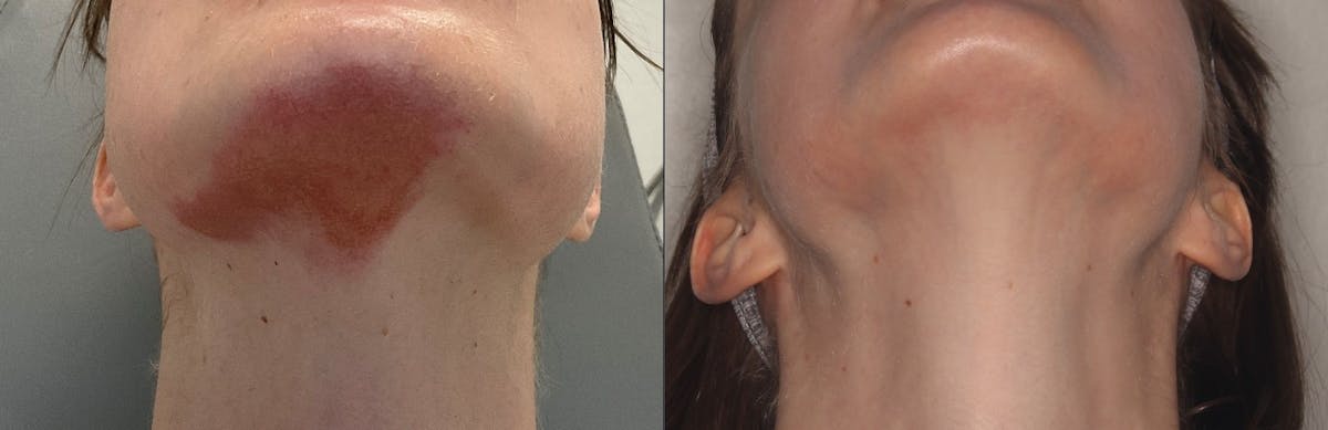 Scar Revision Before & After Gallery - Patient 167340 - Image 1