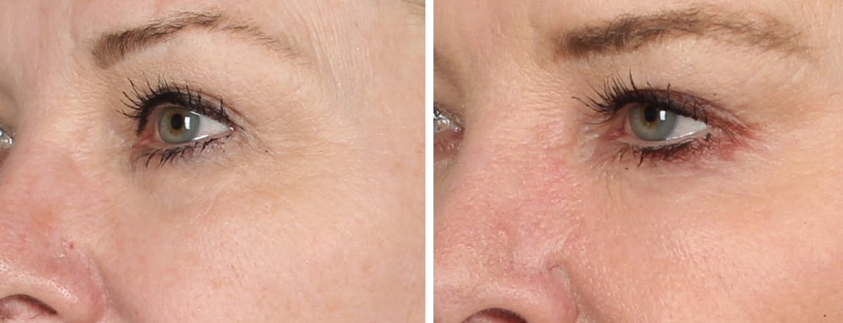 Eyes Before & After Gallery - Patient 425285 - Image 1