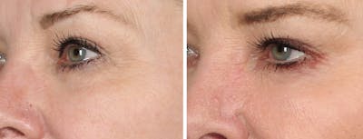Eyes Before & After Gallery - Patient 425285 - Image 1
