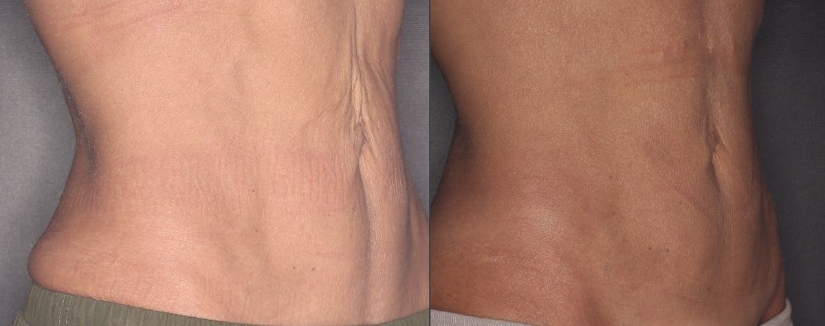 PDO Threads Before & After Gallery - Patient 203468 - Image 1