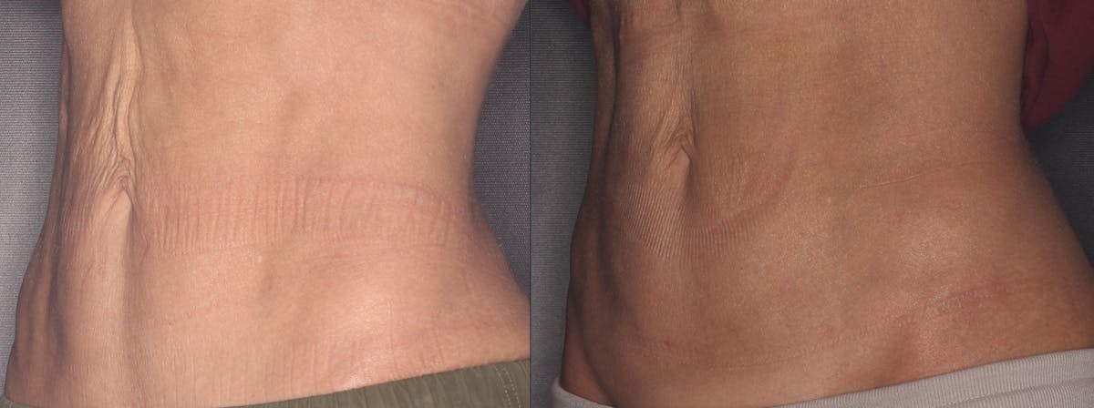 PDO Threads Before & After Gallery - Patient 203468 - Image 2