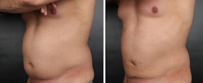 Non-Invasive Fat Reduction Before & After Gallery - Patient 420684 - Image 1