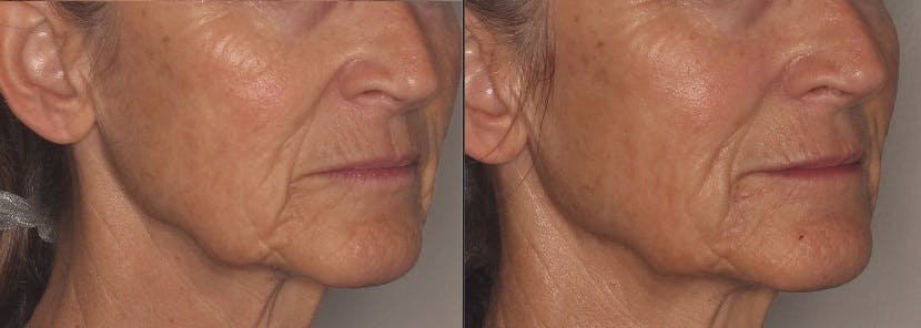 Lower Face Before & After Gallery - Patient 324676 - Image 2
