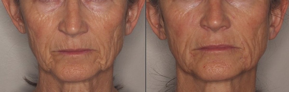Lower Face Before & After Gallery - Patient 324676 - Image 1