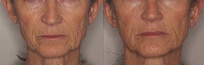 Lower Face Before & After Gallery - Patient 324676 - Image 1