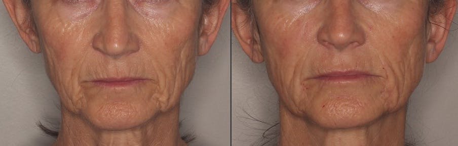 Lower Face Before & After Gallery - Patient 324676 - Image 1