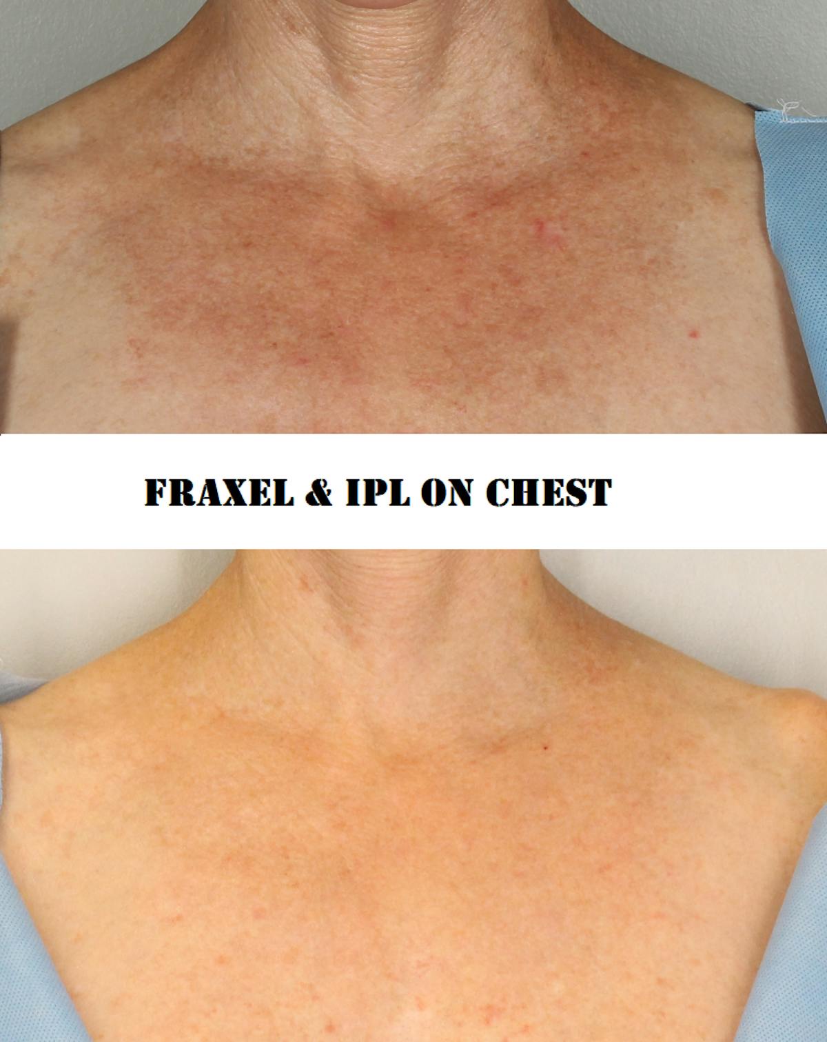 IPL Before & After Gallery - Patient 963388 - Image 1