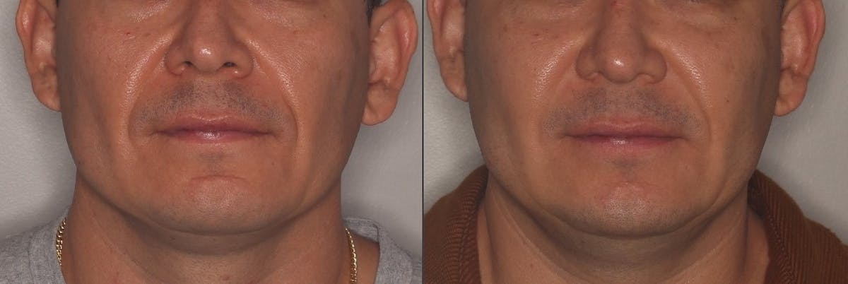 Lower Face Before & After Gallery - Patient 362793 - Image 1