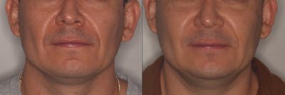 Lower Face Before & After Gallery - Patient 362793 - Image 1