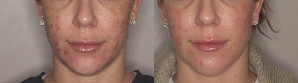 Acne Treatment / Aviclear Before & After Gallery - Patient 257998 - Image 1