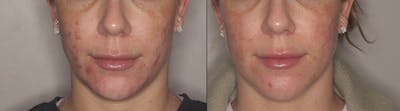 Acne Treatment / Aviclear Before & After Gallery - Patient 257998 - Image 1
