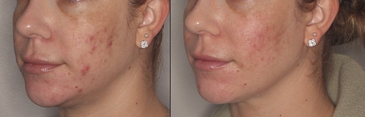 Acne Treatment / Aviclear Before & After Gallery - Patient 257998 - Image 3