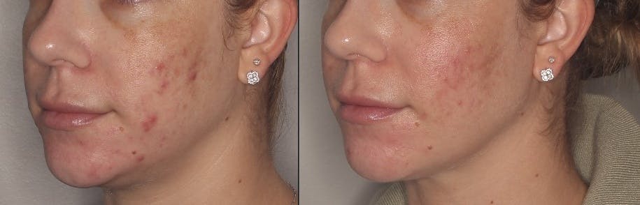 Acne Treatment / Aviclear Before & After Gallery - Patient 257998 - Image 3