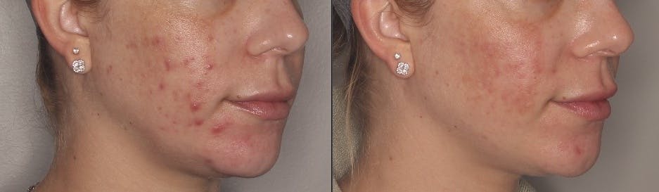 Acne Treatment / Aviclear Before & After Gallery - Patient 257998 - Image 2