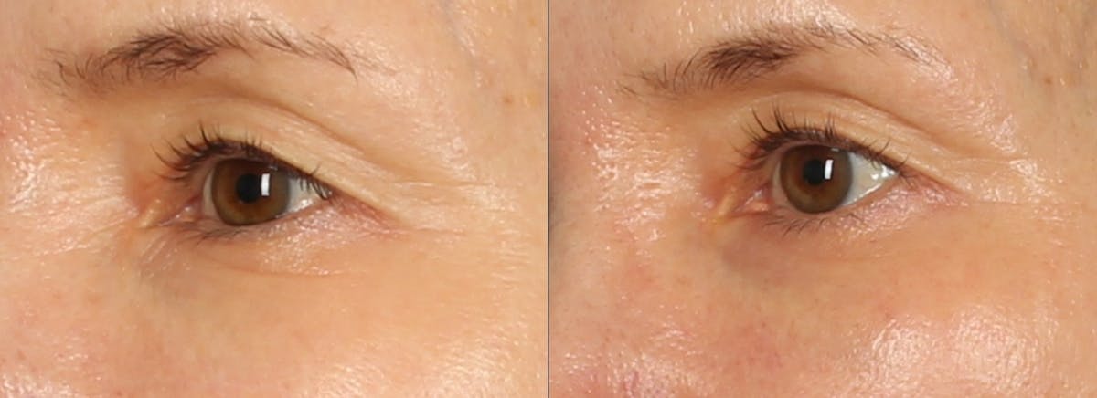 Microneedling Before & After Gallery - Patient 546480 - Image 1