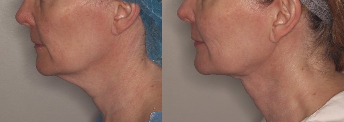 Ellacor Before & After Gallery - Patient 812883 - Image 1