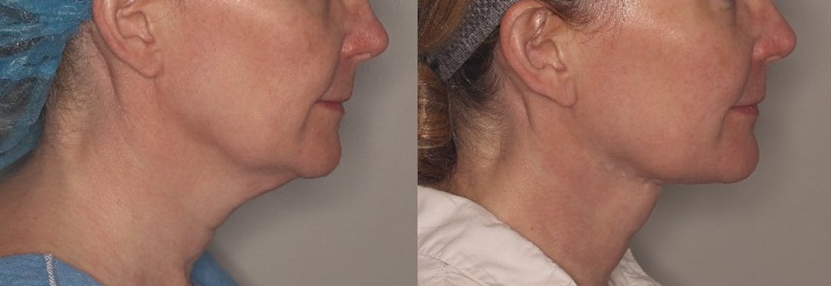 Ellacor Before & After Gallery - Patient 812883 - Image 2
