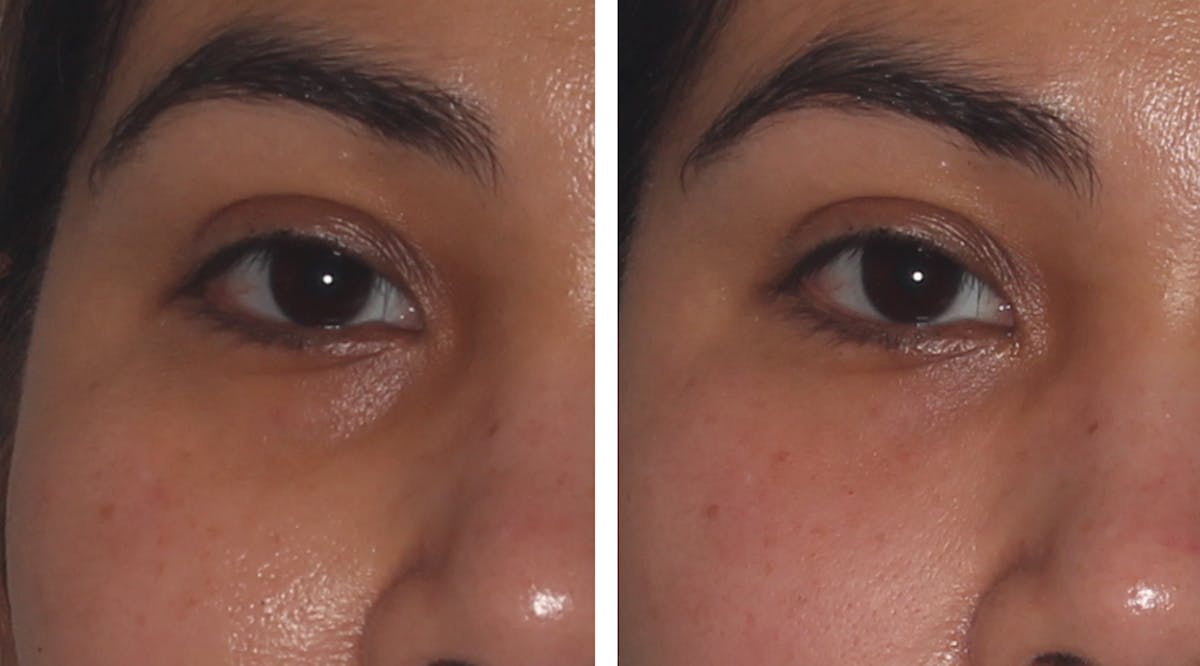 Eyes Before & After Gallery - Patient 333488 - Image 1