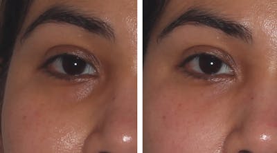 Eyes Before & After Gallery - Patient 333488 - Image 1