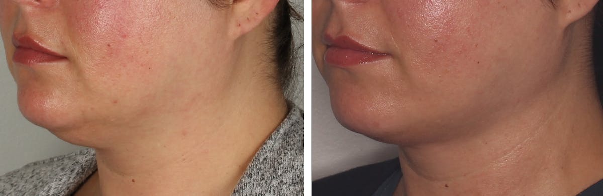 FaceTite & NeckTite Before & After Gallery - Patient 100995 - Image 1