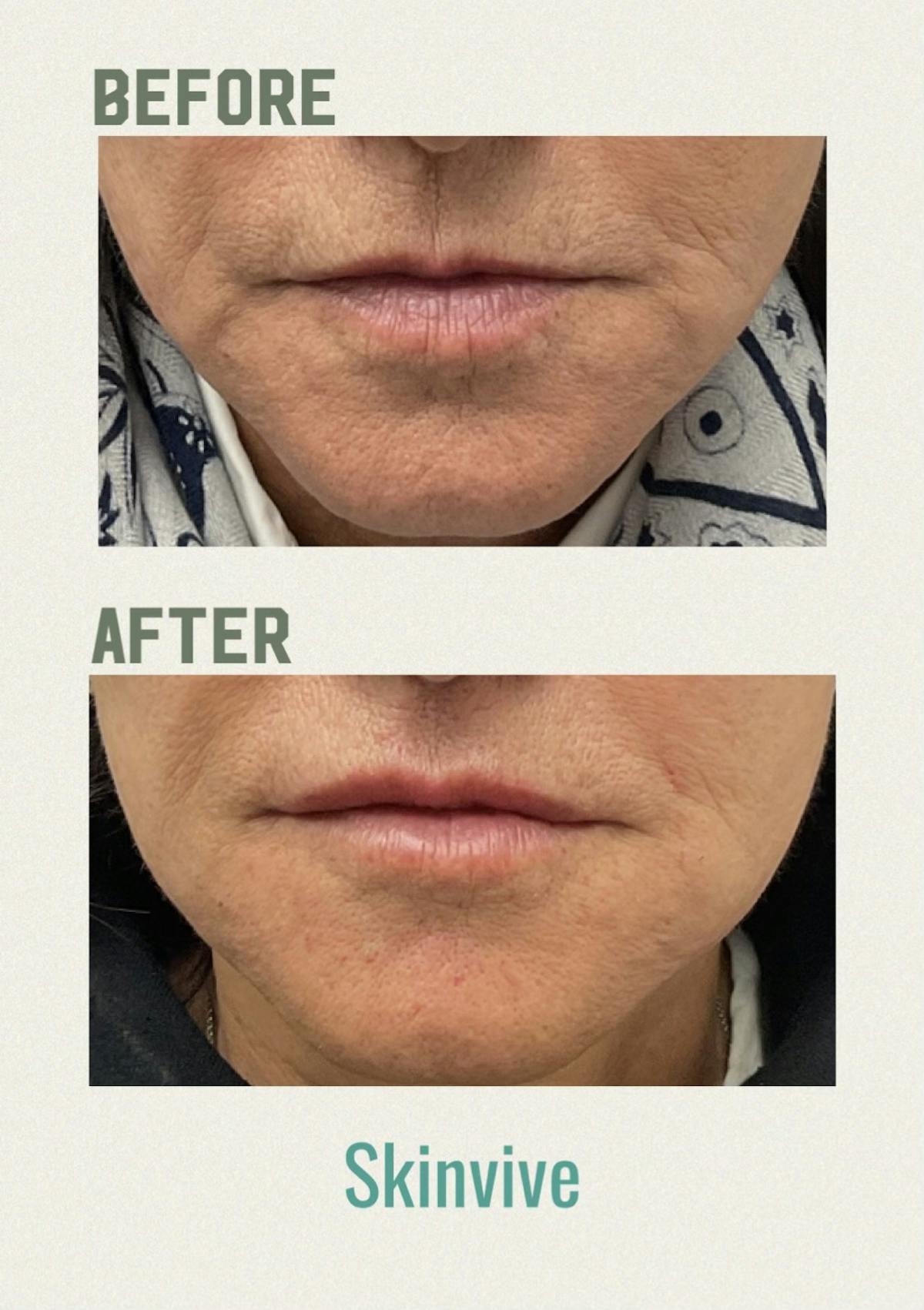 Skinvive Before & After Gallery - Patient 872612 - Image 1