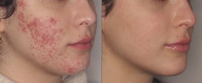 Acne Treatment / Aviclear Before & After Gallery - Patient 377796 - Image 1