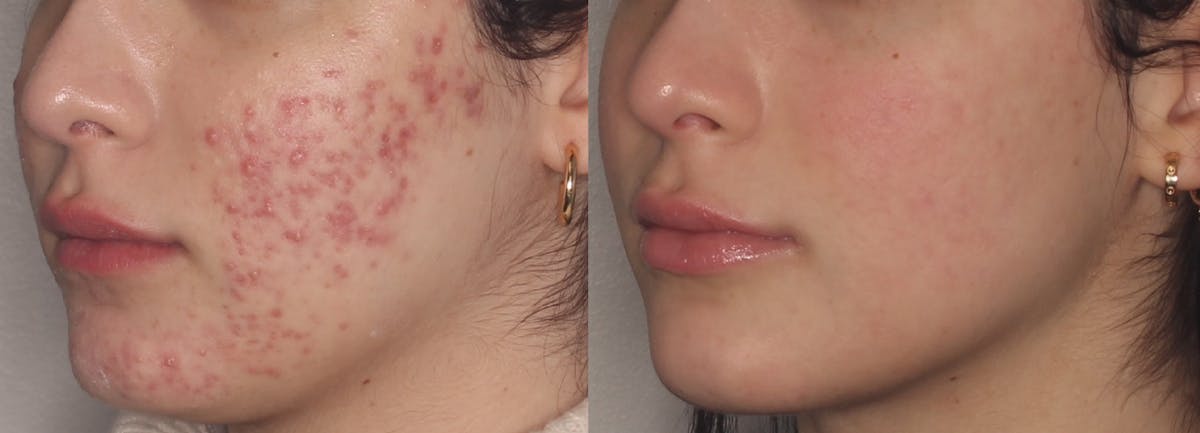 Acne Treatment / Aviclear Before & After Gallery - Patient 295182 - Image 1