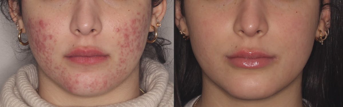 Acne Treatment / Aviclear Before & After Gallery - Patient 168578 - Image 1