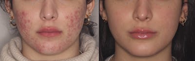 Acne Treatment / Aviclear Before & After Gallery - Patient 168578 - Image 1