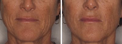 Lower Face Before & After Gallery - Patient 381834 - Image 1