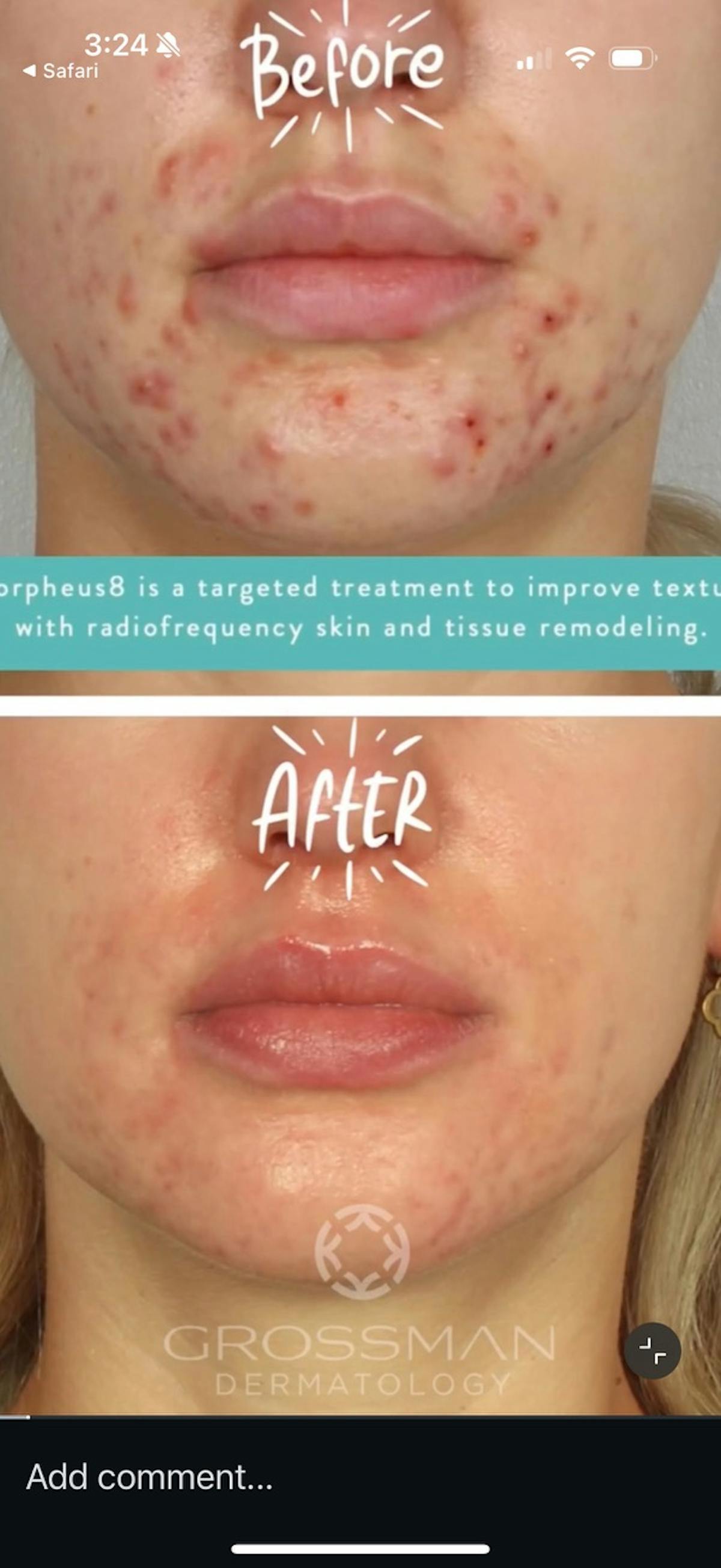 Acne Treatment / Aviclear Before & After Gallery - Patient 145274 - Image 1
