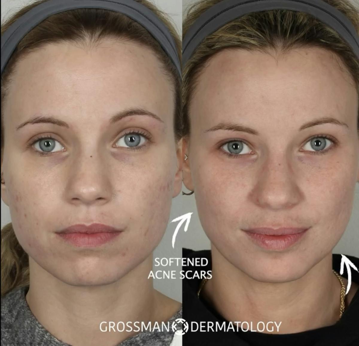 Acne Treatment / Aviclear Before & After Gallery - Patient 214410 - Image 1