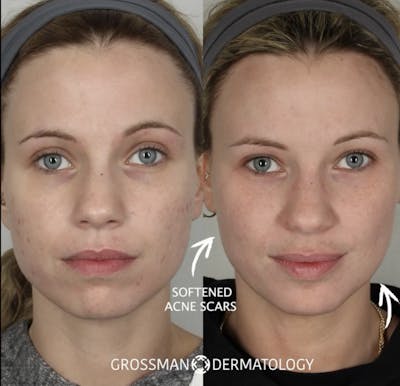 Acne Treatment / Aviclear Before & After Gallery - Patient 214410 - Image 1