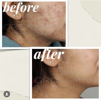 Acne Treatment / Aviclear Before & After Gallery - Patient 131369 - Image 1