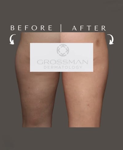 Non-Invasive Fat Reduction Before & After Gallery - Patient 381394 - Image 1