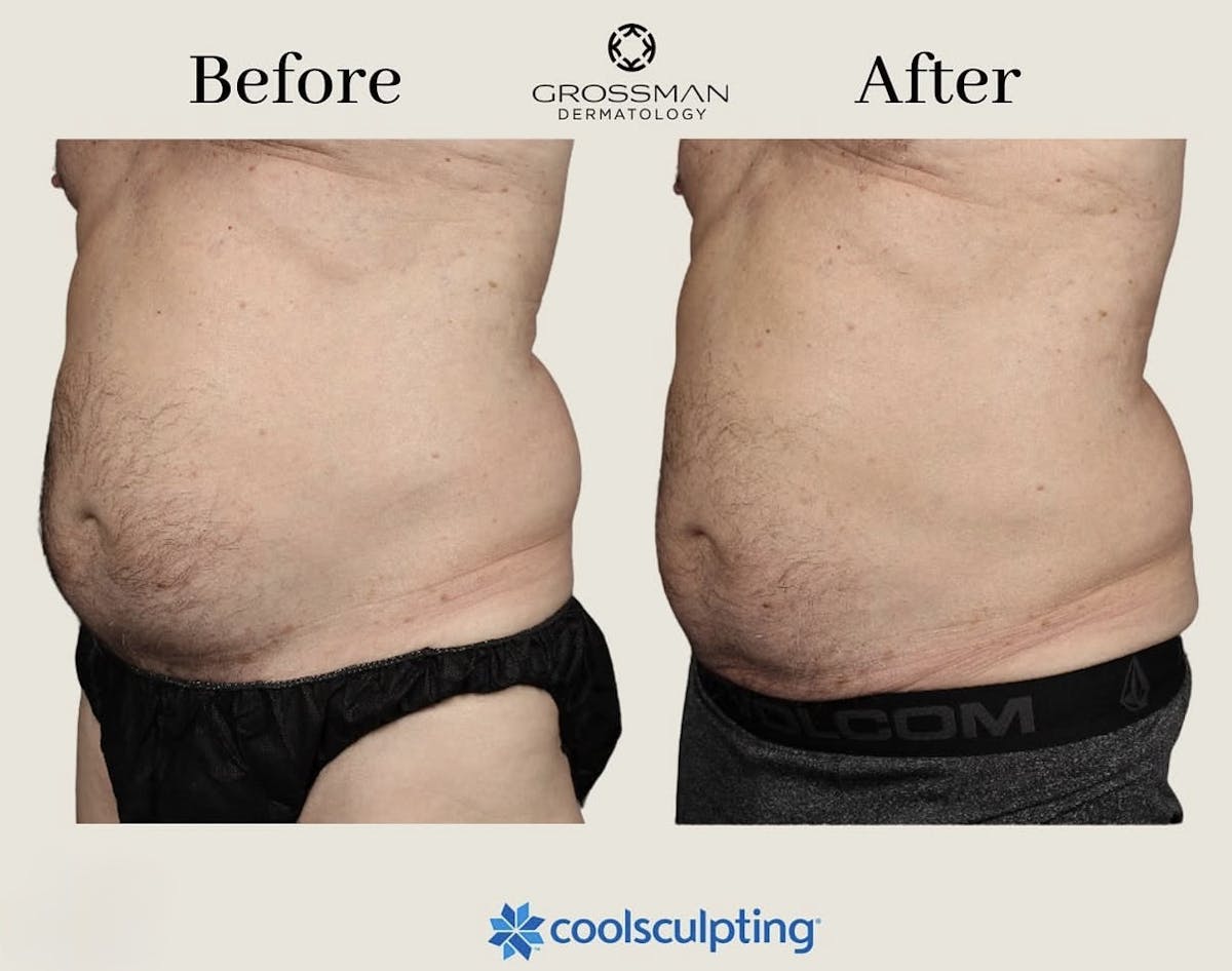 Non-Invasive Fat Reduction Before & After Gallery - Patient 982408 - Image 1