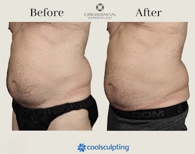 Non-Invasive Fat Reduction Before & After Gallery - Patient 982408 - Image 1