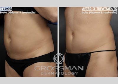 Non-Invasive Fat Reduction Before & After Gallery - Patient 307174 - Image 1