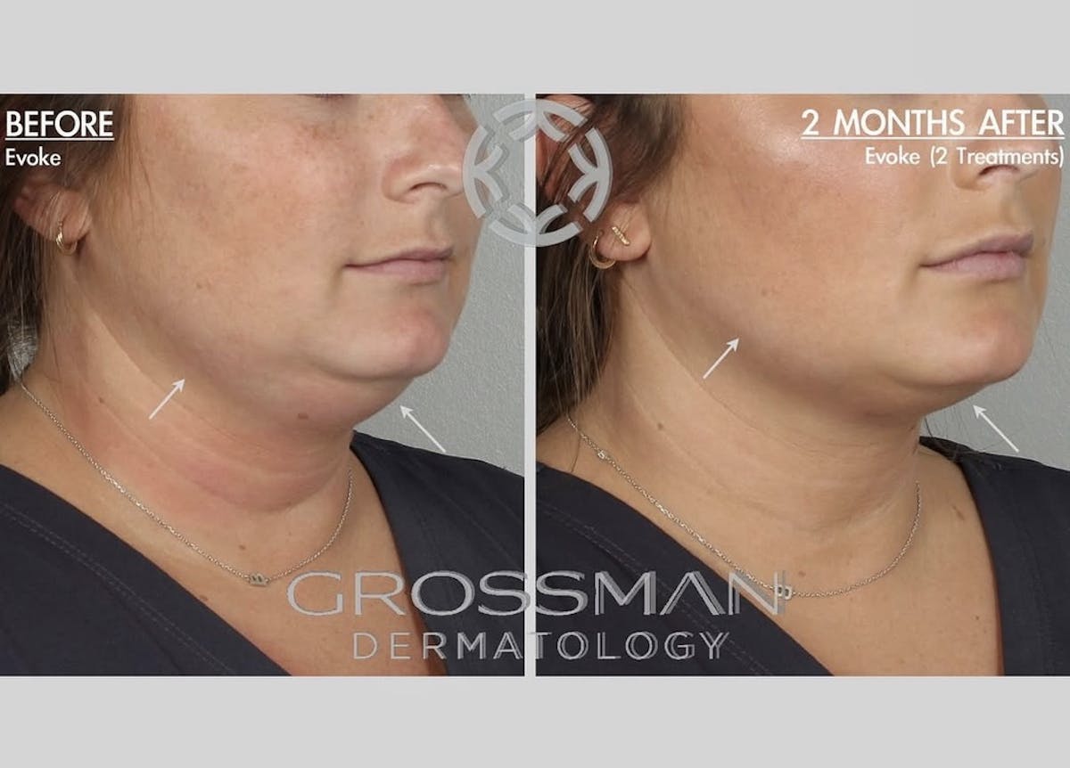 Non-Invasive Fat Reduction Before & After Gallery - Patient 290000 - Image 1