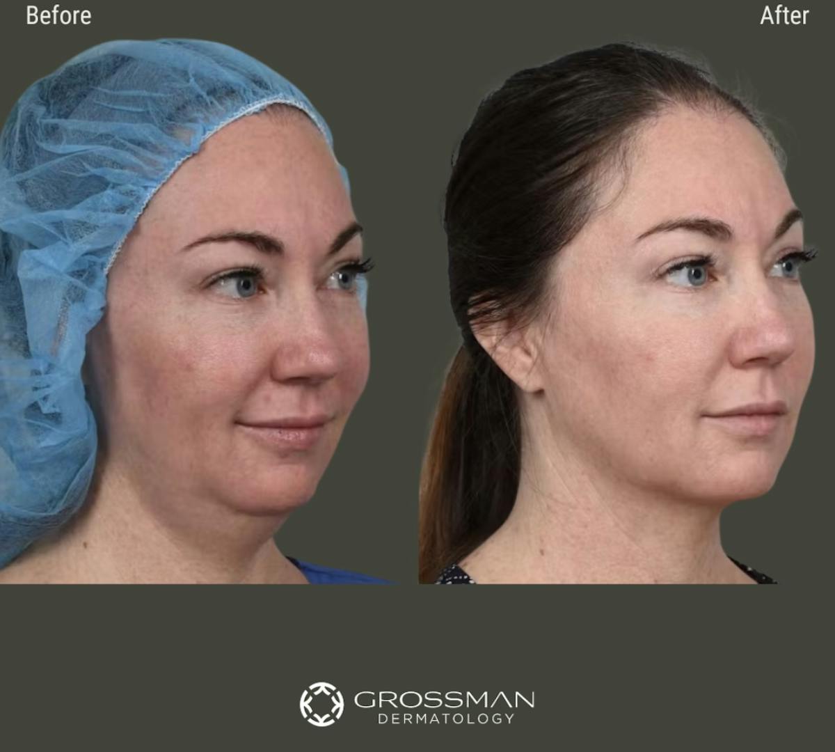 FaceTite & NeckTite Before & After Gallery - Patient 214485 - Image 1