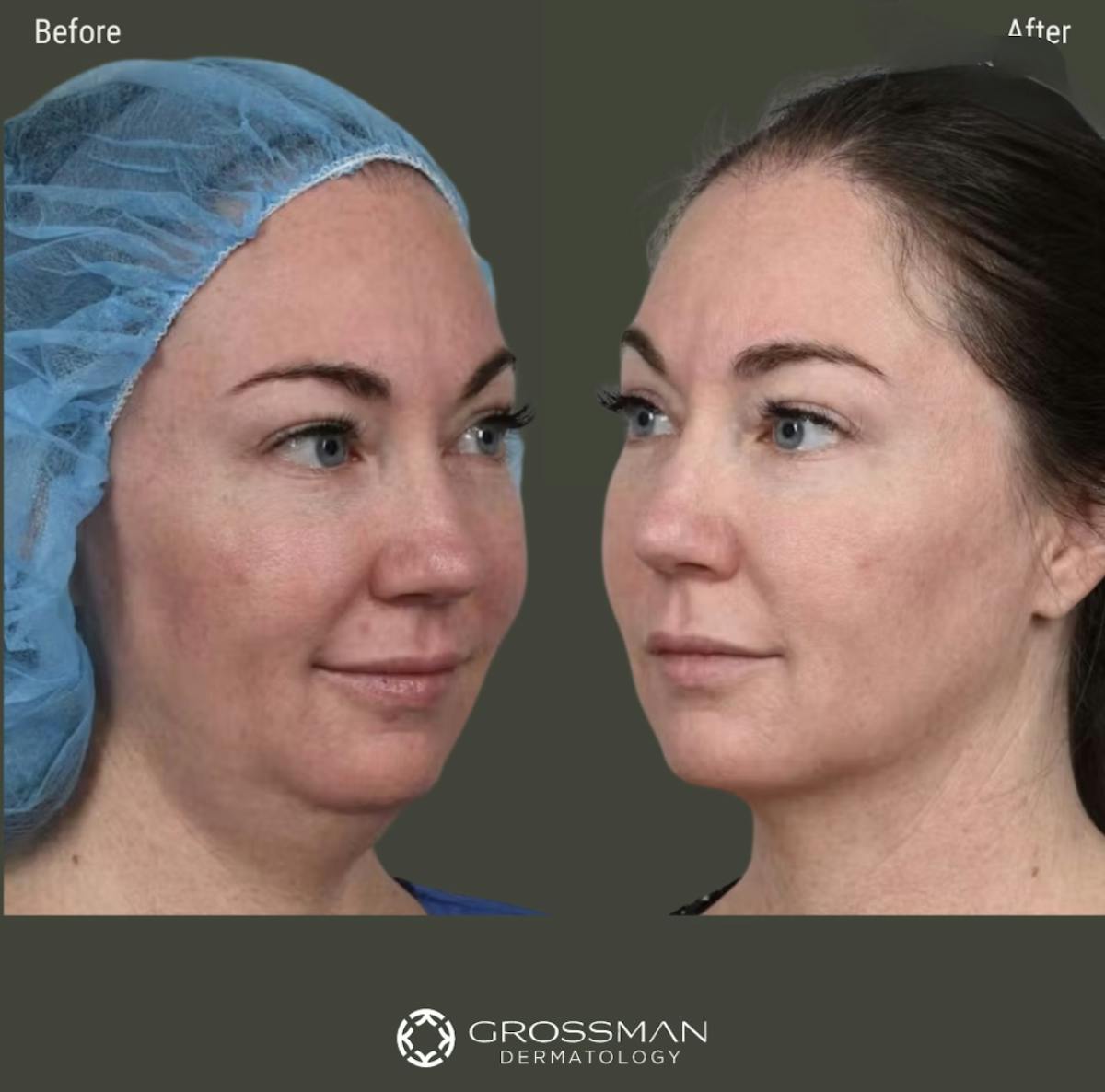 FaceTite & NeckTite Before & After Gallery - Patient 892497 - Image 1