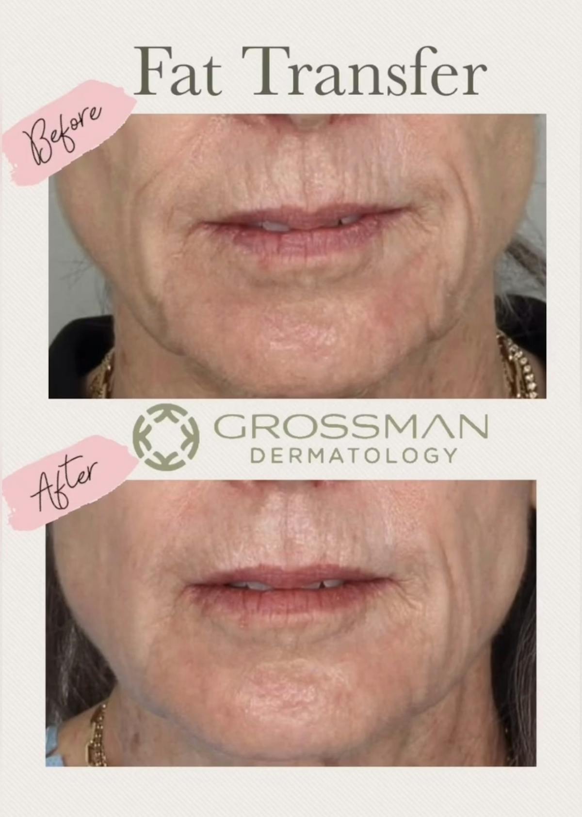 Fat Transfer Before & After Gallery - Patient 405326 - Image 1