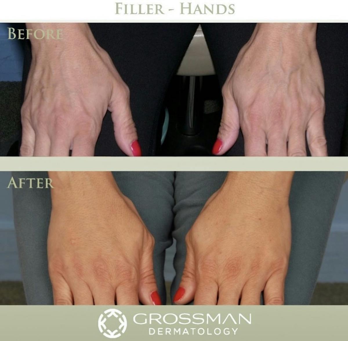 Hands Before & After Gallery - Patient 199214 - Image 1