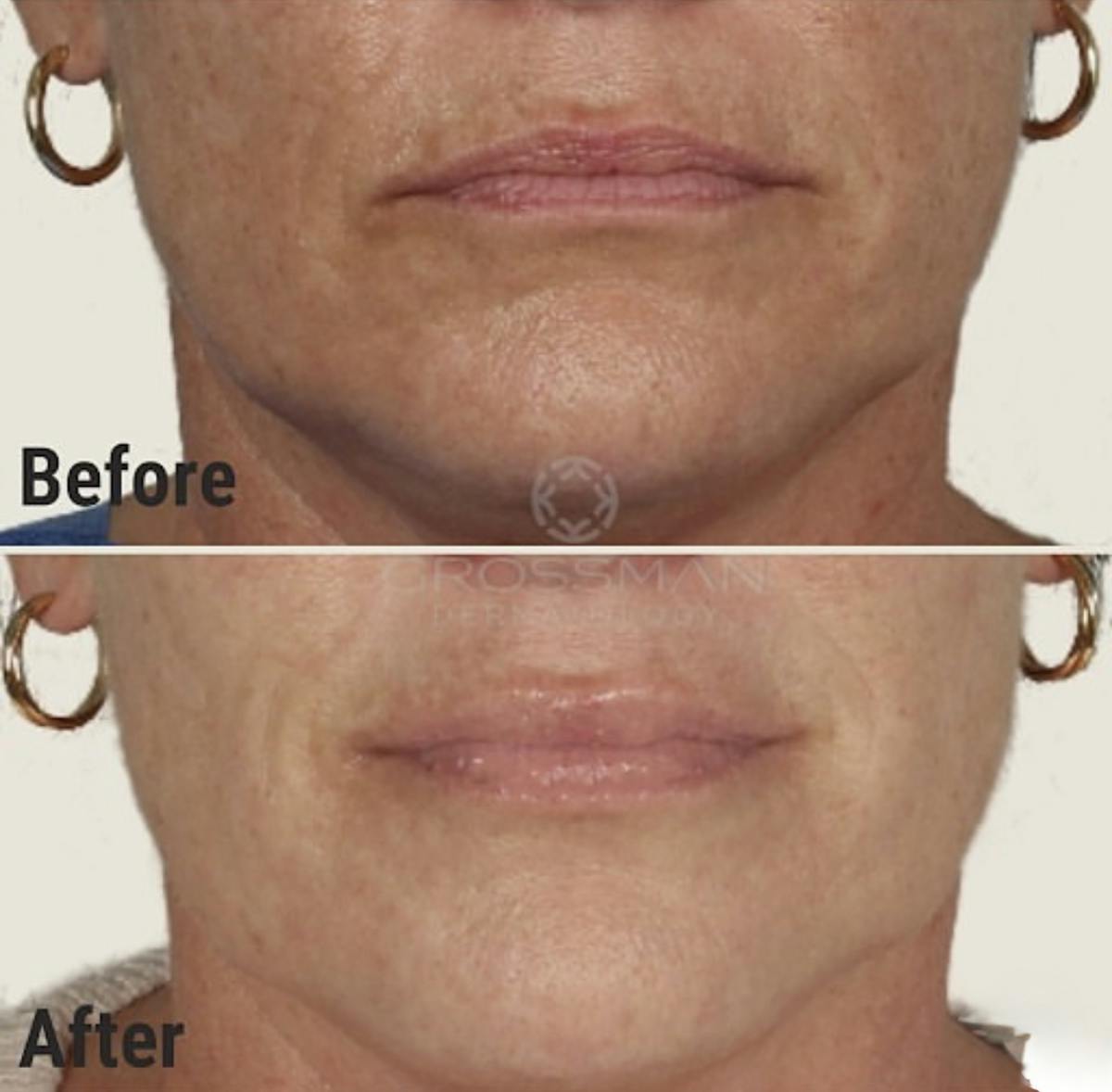 Lower Face Before & After Gallery - Patient 333927 - Image 1