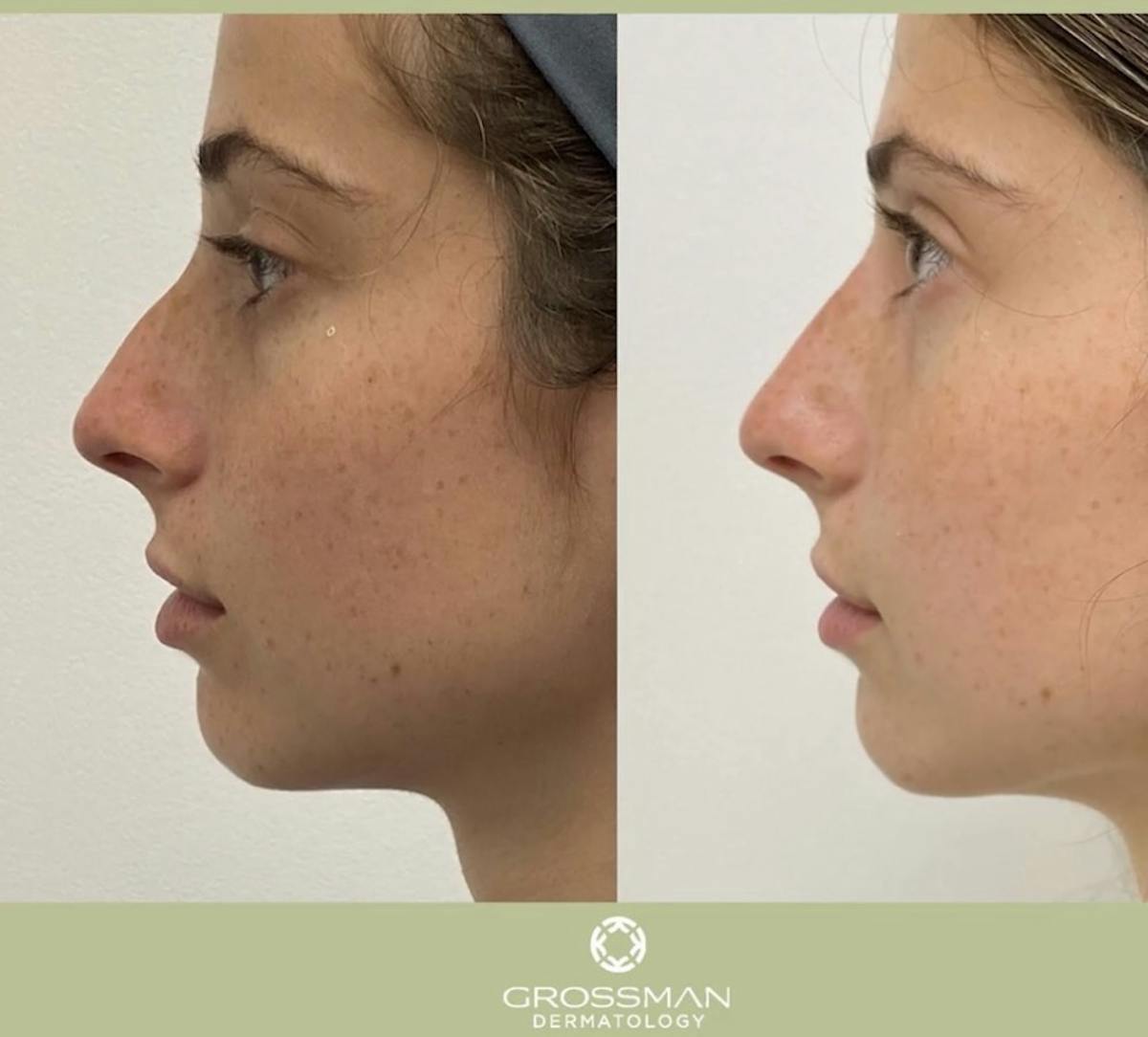 Lower Face Before & After Gallery - Patient 300436 - Image 1