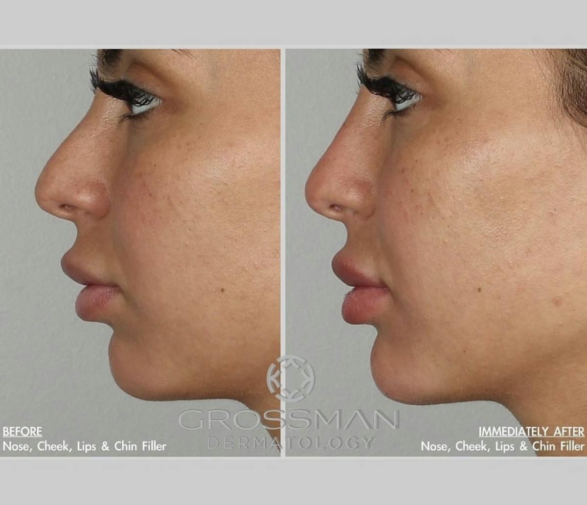 Lips Before & After Gallery - Patient 232243 - Image 1