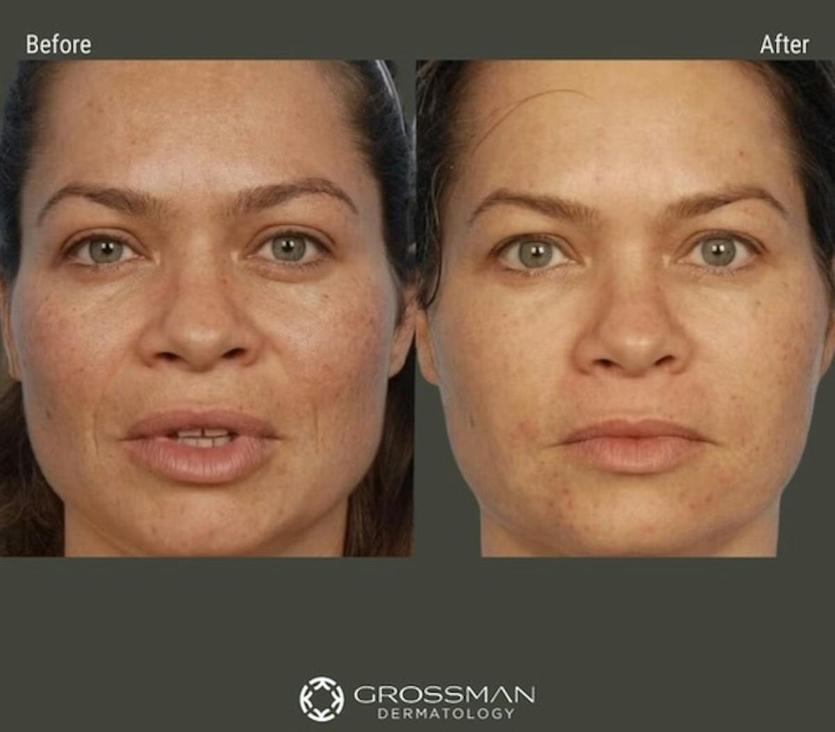 Fraxel Laser Before & After Gallery - Patient 261268 - Image 1