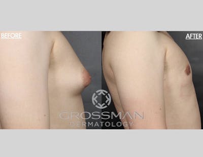 Non-Invasive Fat Reduction Before & After Gallery - Patient 406692 - Image 1