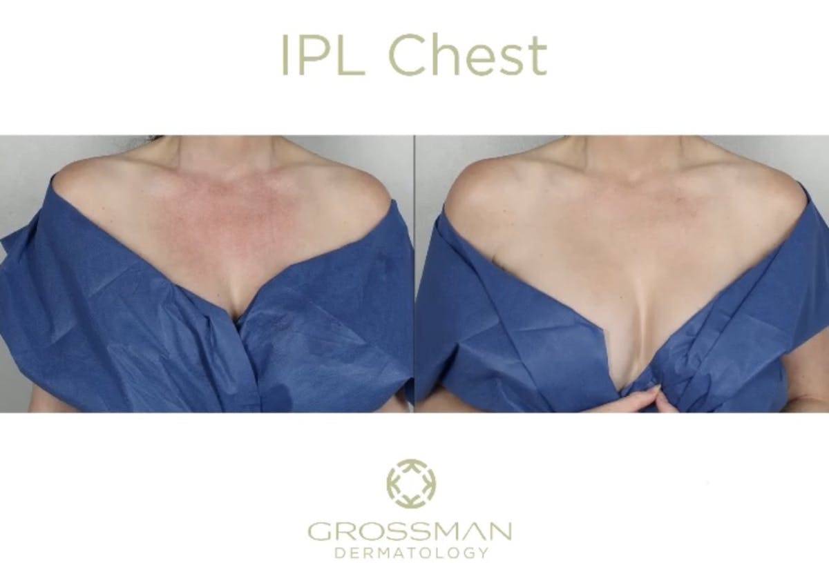 IPL Before & After Gallery - Patient 872835 - Image 1